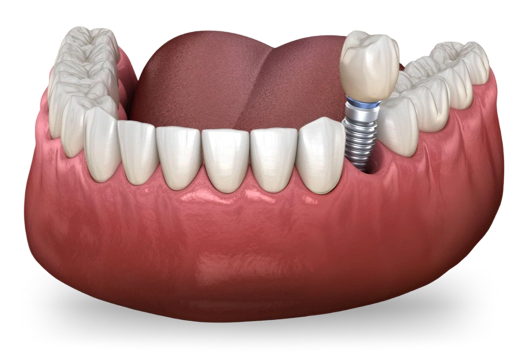 Dental implant model showing artificial tooth fixture integrated into gum tissue with natural teeth.