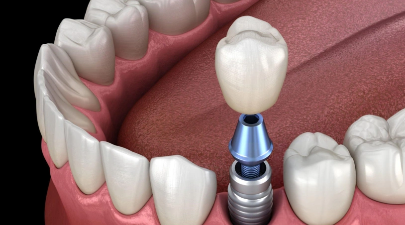 Dental implant model showing artificial tooth crown on implant fixture among natural teeth.